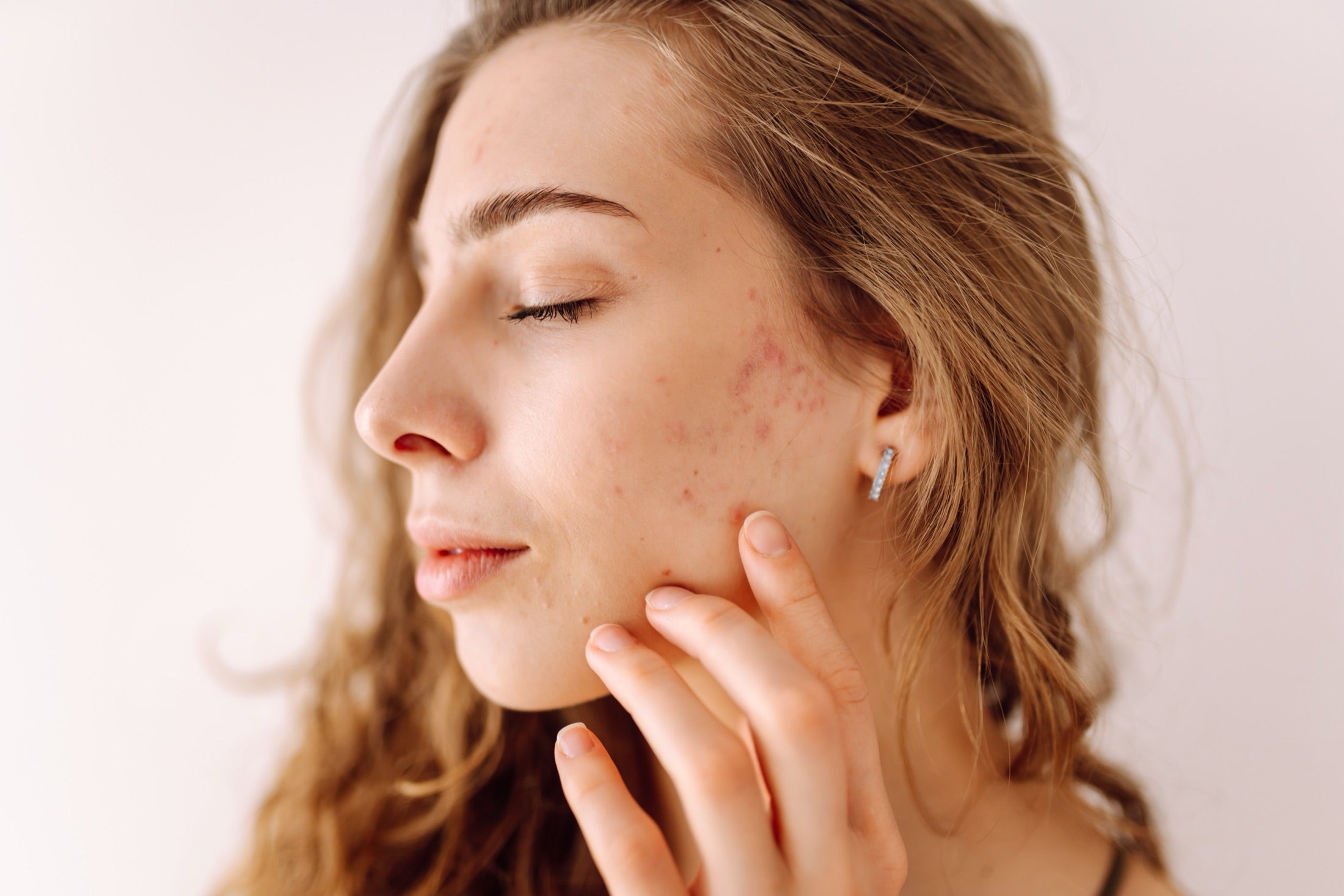 How to calm skin inflammation naturally with Ayurvedic skincare - Ayurscience